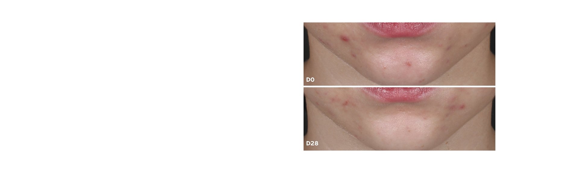 banner acné