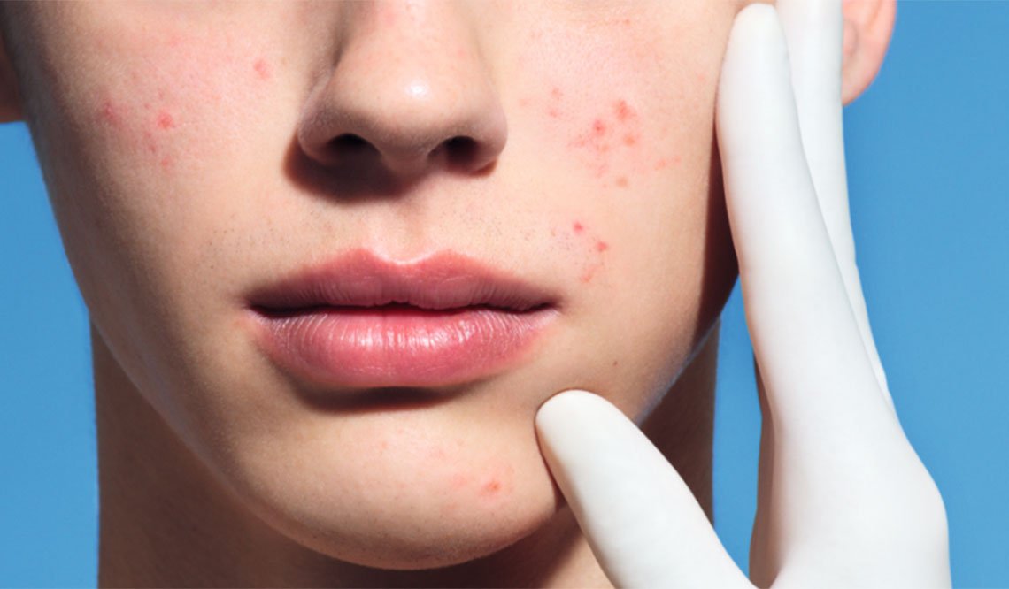Larocheposay-SubCategoryPage-Acne-What-causes-oily-acne-prone-skin-how-to-prevent-it